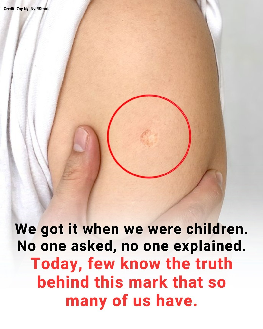 The Truth Behind the Mysterious Round Scar on the Upper Arm