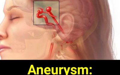 Silent Aneurysms: Why Some Brain Conditions Go Unnoticed