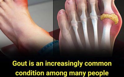 Those with gout should absolutely avoid these foods