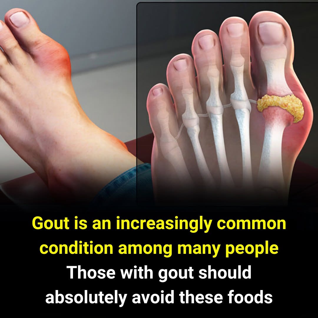 Those with gout should absolutely avoid these foods