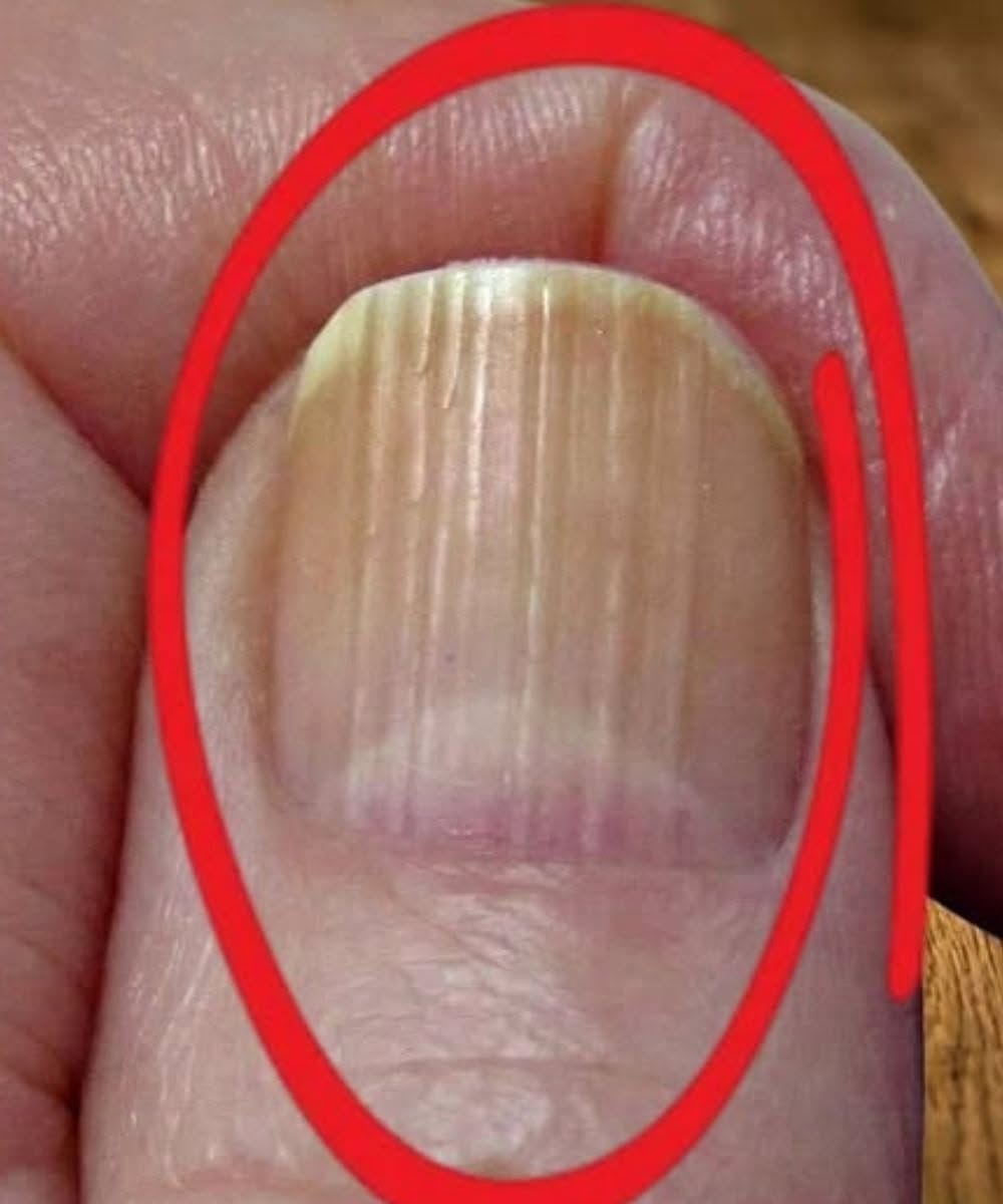 Če imate na nohtih črte, to pomeni, da imate … Več o tem ⤵️