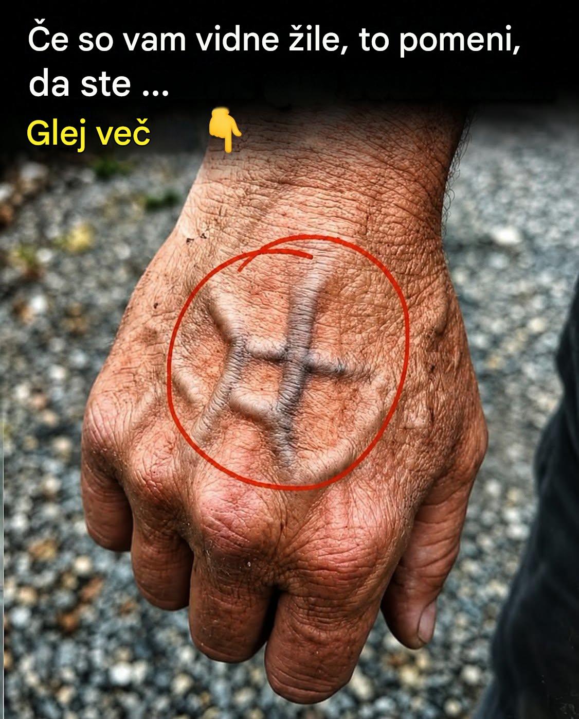 Kdaj bi vas morale skrbeti žile, ki se nenadoma pojavijo?