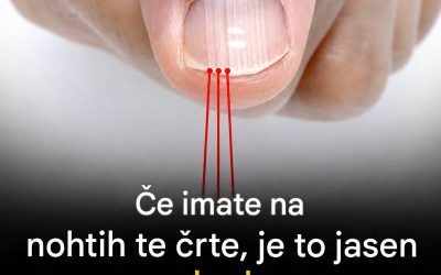 Navpične gube na nohtih: kaj vam telo vsak dan sporoča