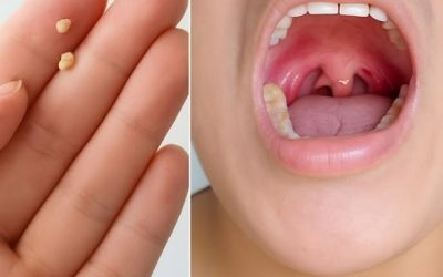 Home Remedy for Fresh Breath (Against Tonsil Stones & Bad Odor)