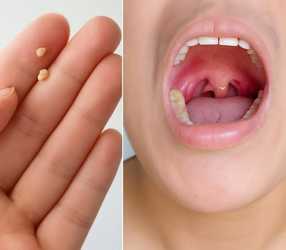 Home Remedy for Fresh Breath (Against Tonsil Stones & Bad Odor)