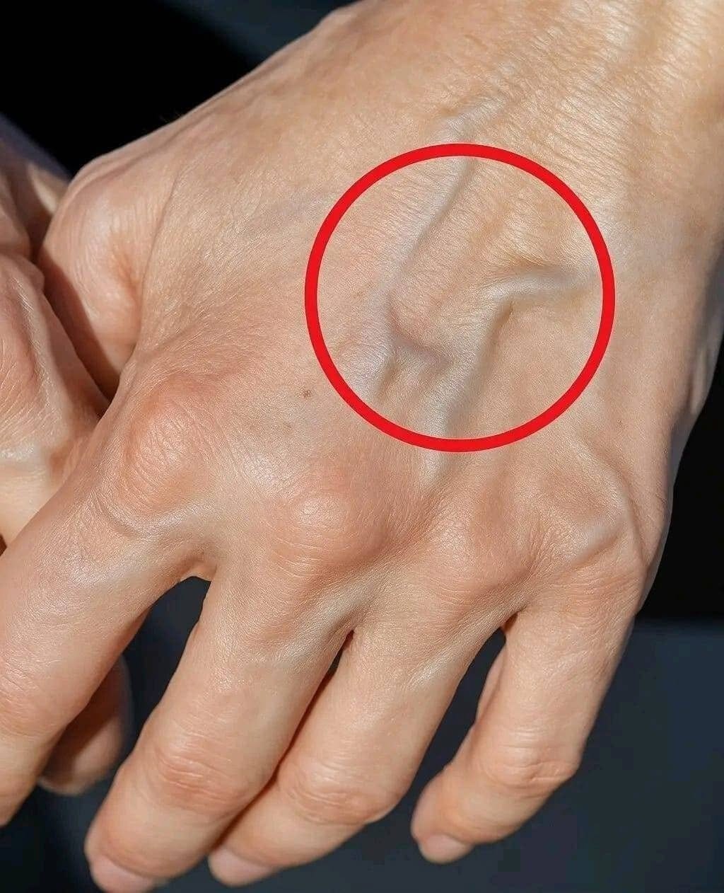 Vidne žile: kaj pomenijo in zakaj jih lahko vidite