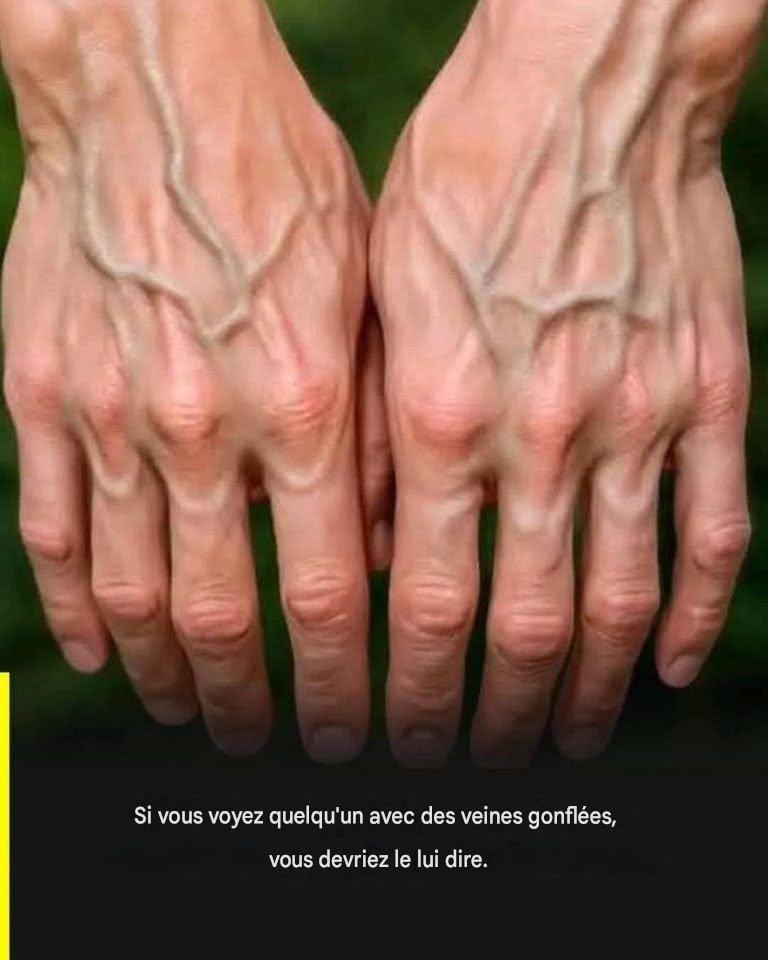 Če so vam vidne žile, to pomeni, da … Več o tem