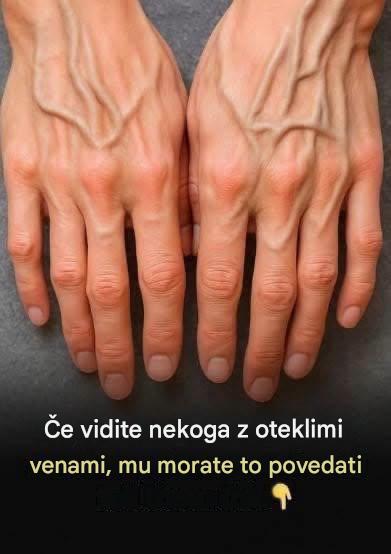 Kaj v resnici pomenijo vidne žile? Razumevanje vzrokov in kdaj je treba biti pozoren