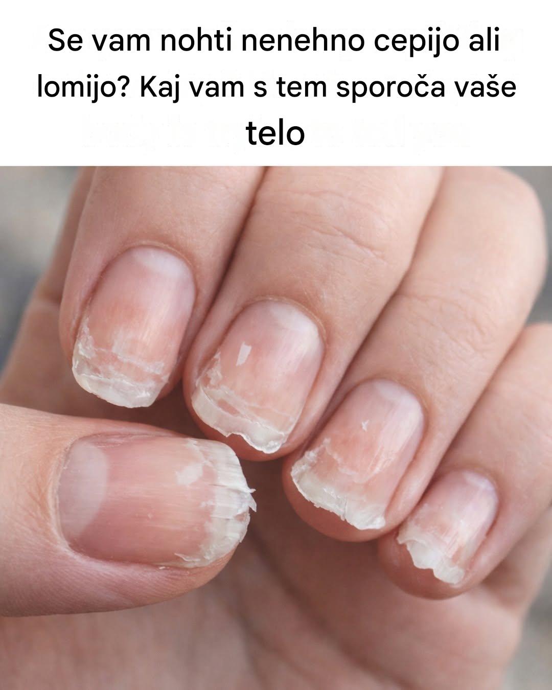 Kaj vam lahko šibki ali krhki nohti povedo o vašem zdravju