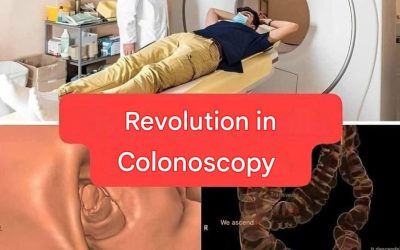 New method, colonoscopy will no longer be an invasive test