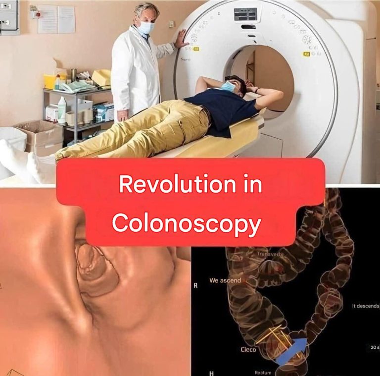 New method, colonoscopy will no longer be an invasive test