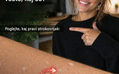 Zakaj se na koži pojavijo bele lise?🤯😱😱