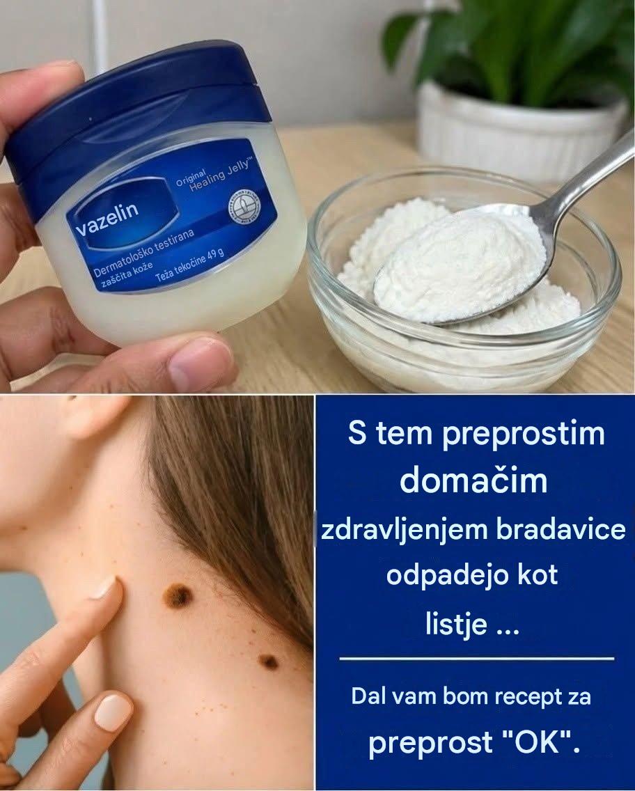 Bradavice odpadajo kot listje s tem preprostim domačim zdravljenjem
